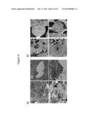 LARGE ONCOSOMES IN HUMAN TUMORS AND IN CIRCULATION IN PATIENTS WITH CANCER diagram and image