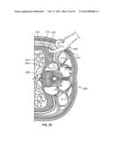 Surgical Access System and Related Methods diagram and image