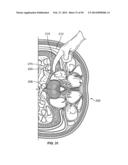 Surgical Access System and Related Methods diagram and image