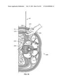 Surgical Access System and Related Methods diagram and image