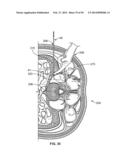 Surgical Access System and Related Methods diagram and image