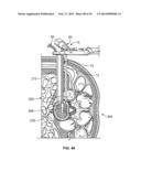 Surgical Access System and Related Methods diagram and image