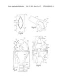 ROBOTIC ARTHROPLASTY SYSTEM INCLUDING NAVIGATION diagram and image