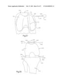 ROBOTIC ARTHROPLASTY SYSTEM INCLUDING NAVIGATION diagram and image