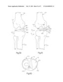 ROBOTIC ARTHROPLASTY SYSTEM INCLUDING NAVIGATION diagram and image