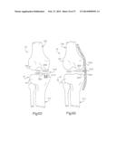 ROBOTIC ARTHROPLASTY SYSTEM INCLUDING NAVIGATION diagram and image