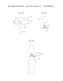 ROBOTIC ARTHROPLASTY SYSTEM INCLUDING NAVIGATION diagram and image