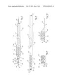 ANCHORING DEVICE FOR ANCHORING A BORING TOOL IN A LUMEN OR VESSEL diagram and image