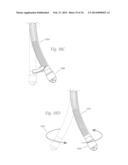 ATHERECTOMY APPARATUS, SYSTEMS AND METHODS diagram and image