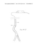 ATHERECTOMY APPARATUS, SYSTEMS AND METHODS diagram and image