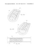 ATHERECTOMY APPARATUS, SYSTEMS AND METHODS diagram and image