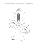 Bone Fixation System diagram and image