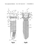 Bone Fixation System diagram and image