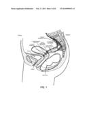 DEVICES AND METHODS FOR STIMULATING NERVES diagram and image