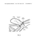 DEVICES AND METHODS FOR STIMULATING NERVES diagram and image