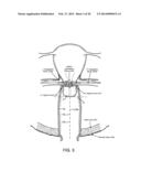 DEVICES AND METHODS FOR STIMULATING NERVES diagram and image