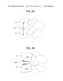 Insertion tool for Inter-body Vertebral Prosthetic Device With     Self-Deploying Screws diagram and image