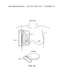 VERSATILE BREAST ULTRASOUND SCANNING diagram and image