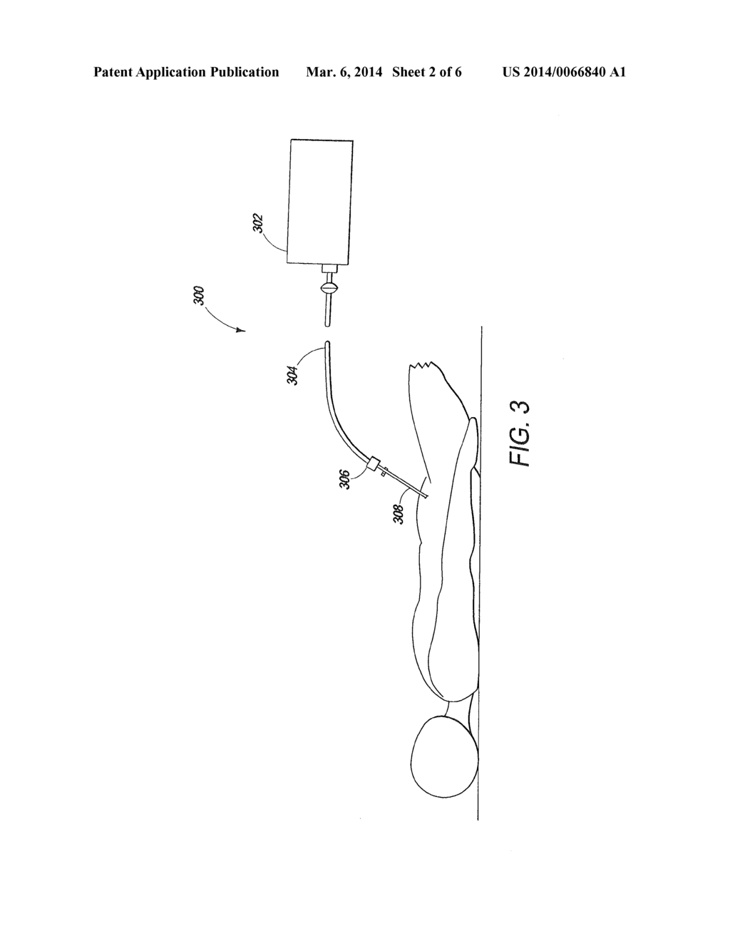 High-Flow Luer Lock Connector for a Luer Lock Connection - diagram, schematic, and image 03