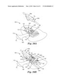 MEDICAL ARTICLE SECUREMENT SYSTEMS COMPRISING A BRACKET AND A FLAP diagram and image