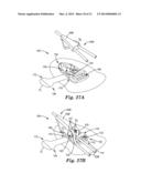 MEDICAL ARTICLE SECUREMENT SYSTEMS COMPRISING A BRACKET AND A FLAP diagram and image