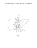 BALLOON CATHETER NEUROMODULATION SYSTEMS diagram and image