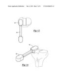 Bi-Cruciate Knee System diagram and image
