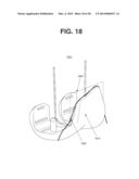 PATIENT SPECIFIC IMPLANT POSITIONING diagram and image