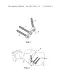 IMPLANT SUITABLE FOR CALCANEAL OSTEOTOMY diagram and image