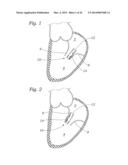 Heart Valve Sealing Devices diagram and image