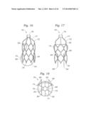 Heart Valve Sealing Devices diagram and image