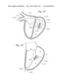 Heart Valve Sealing Devices diagram and image