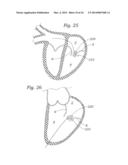 Heart Valve Sealing Devices diagram and image