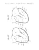 Heart Valve Sealing Devices diagram and image