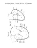 Heart Valve Sealing Devices diagram and image