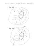 Heart Valve Sealing Devices diagram and image