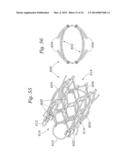 Heart Valve Sealing Devices diagram and image