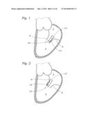 Heart Valve Sealing Devices diagram and image