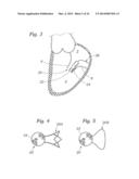 Heart Valve Sealing Devices diagram and image