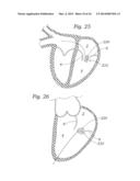 Heart Valve Sealing Devices diagram and image