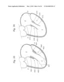 Heart Valve Sealing Devices diagram and image