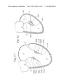 Heart Valve Sealing Devices diagram and image