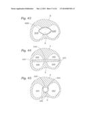 Heart Valve Sealing Devices diagram and image