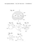 Heart Valve Sealing Devices diagram and image