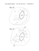 Heart Valve Sealing Devices diagram and image