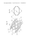 Heart Valve Sealing Devices diagram and image