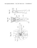 Heart Valve Sealing Devices diagram and image