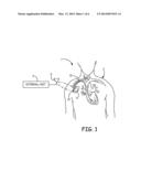 TRIM ALGORITHM FOR A MEDICAL DEVICE ANTENNA diagram and image