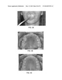 INTRA-ORAL LIGHT THERAPY APPARATUSES AND METHODS FOR THEIR USE diagram and image