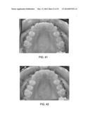 INTRA-ORAL LIGHT THERAPY APPARATUSES AND METHODS FOR THEIR USE diagram and image